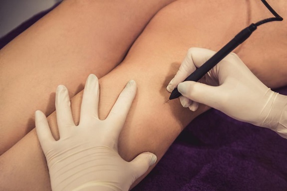 hair removal using electrolysis