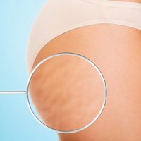 The Stretch marks and the Process of Spray Tanning