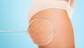 The Stretch marks and the Process of Spray Tanning