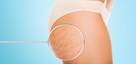 The Stretch marks and the Process of Spray Tanning